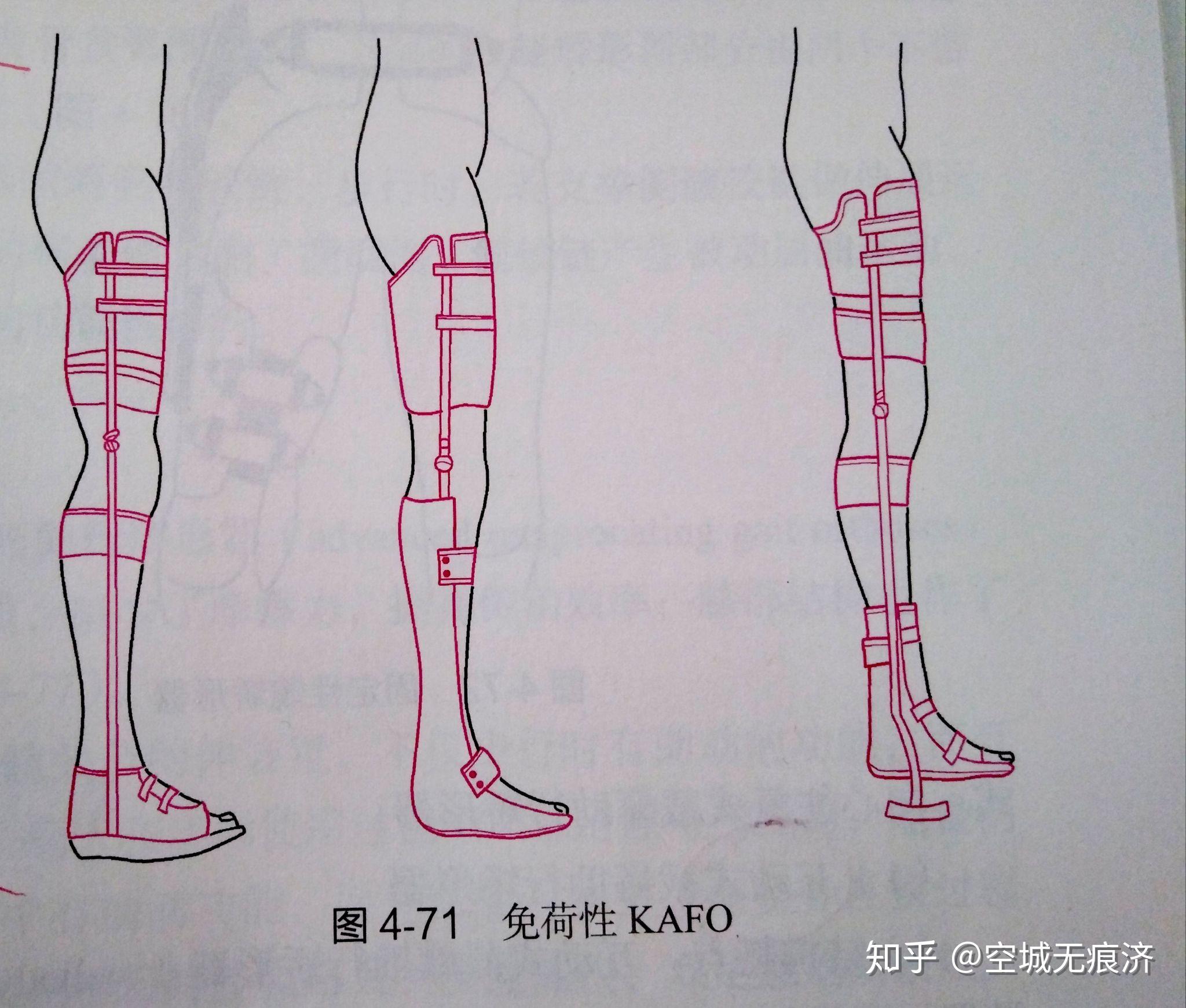 臨床康復(fù)工程學(xué) 假肢與矯形器的功能、設(shè)計(jì)與發(fā)展